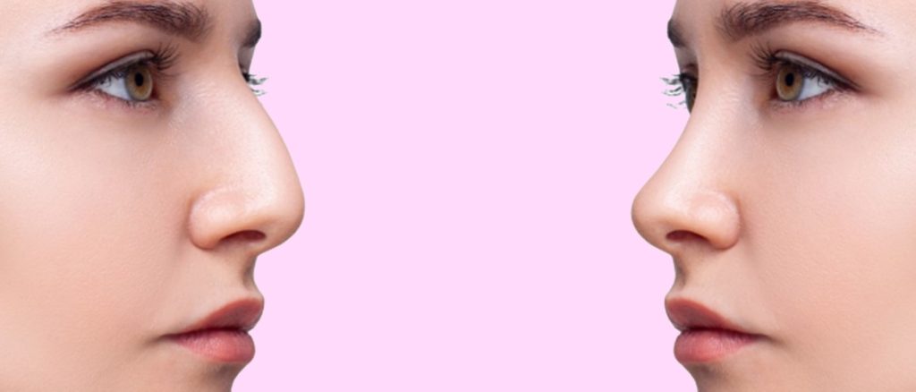 Burun Estetiği