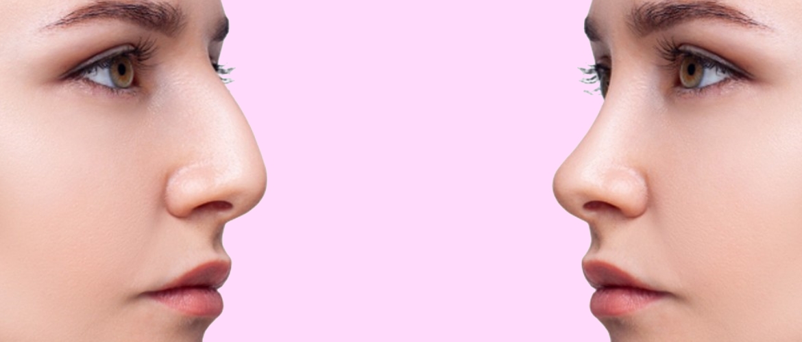 Burun Estetiği